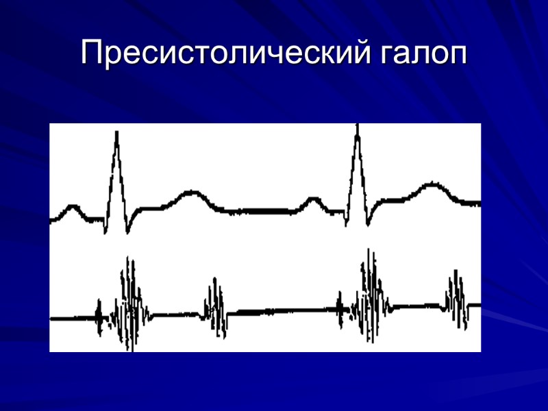 Пресистолический галоп Пресистолический галоп